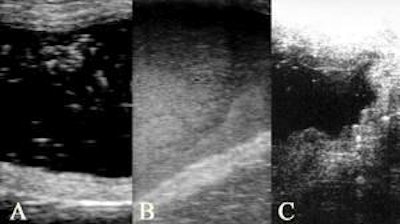 Images of the urinary bladder. A) Slight amounts of sediment (a few white spots within the black, i.e. urine); B) High amounts of sediment (almost no black, i.e. urine); C) Bladder with irregular shaped wall having also a heterogeneous echotexture. This sow also had a thick purulent discharge and evidently had a cystitis.