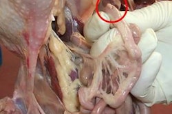 Figure 1. Meckel’s diverticulum (yolk stalk)