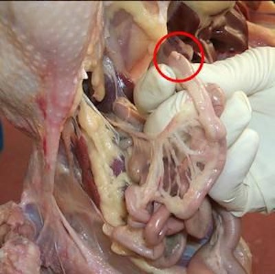 Figure 1. Meckel’s diverticulum (yolk stalk)