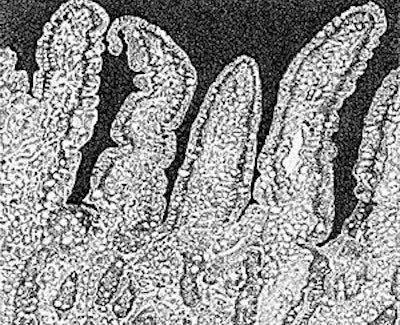 A healthy intestinal wall has long, finger shaped villi that provide an enormous surface for digestion and absorption of nutrients. In case of intestinal damage the villi are shortened which impairs digestion and absorption. The nutrients are left over in the lumen as a substrate for bacteria, causing bacterial overgrowth and disease.