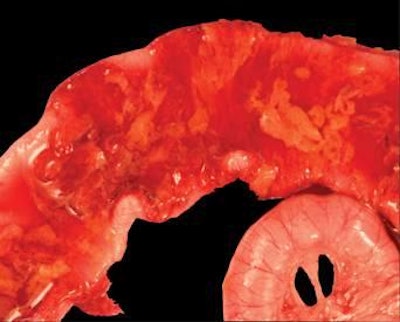 Foto cortesía de Zoetis | Lesión +4 de Eimeria maxima: La pared intestinal puede estar inflamada en la mayor parte de su longitud, además de engrosada, con muchos coágulos sanguíneos y eritrocitos digeridos, lo que le da su color y olor putrefacto característico.